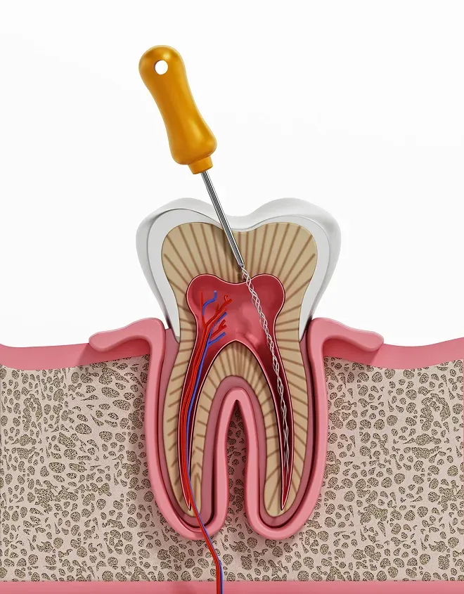 Can a Root Canal Save My Tooth? Long-Term Success Rates