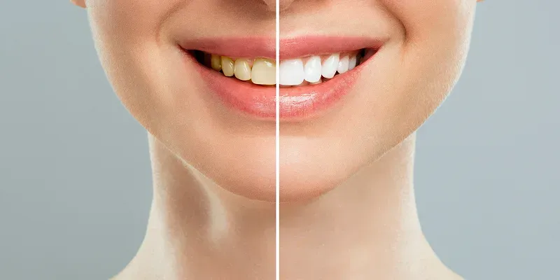 Professional teeth whitening before and after smile treatment in Union City