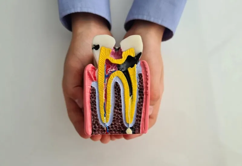 Root Canal Retreatment: What HaRoot Canal Retreatment: What Happens If a Root Canal Fails? ppens If a Root Canal Fails?