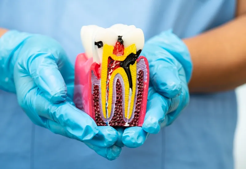 Patient learning about root canal treatment and tooth extraction options in Union City