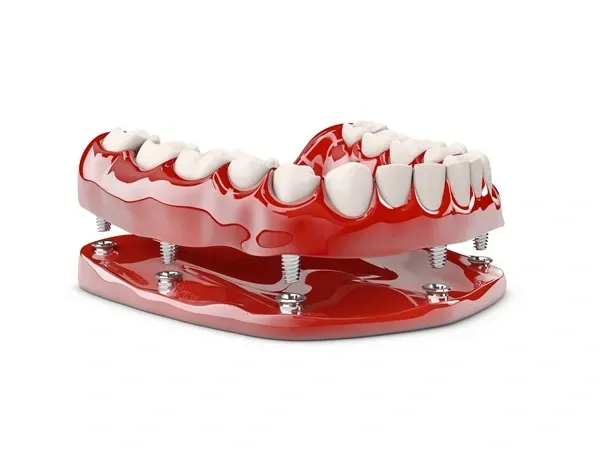 The_Future_of_Implant_Dentures_bf59586348.webp