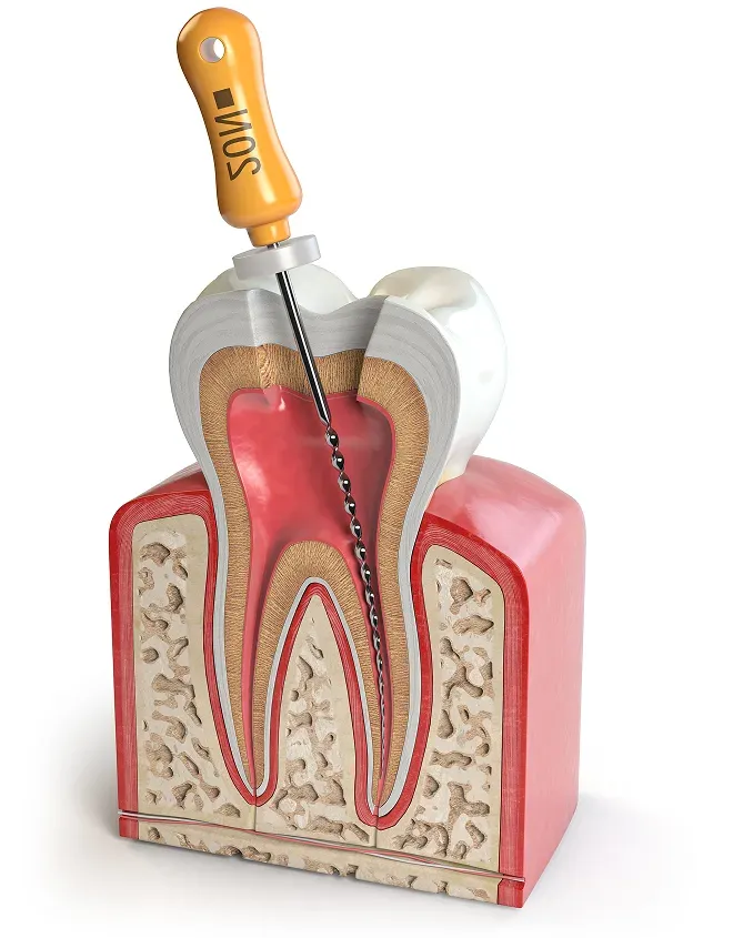 Union City Root Canal illustration showing infected pulp removal